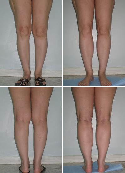Как уменьшить толстые икры ног. липосакция голени - андрей искорнев