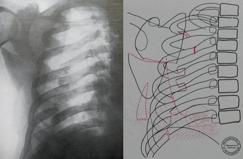 Трещина в ребре какие симптомы. Флотирующий перелом ребер. Окончатые переломы ребер рентген. Перелом ребер рентгенограмма. Неконсолидированный перелом ребра.