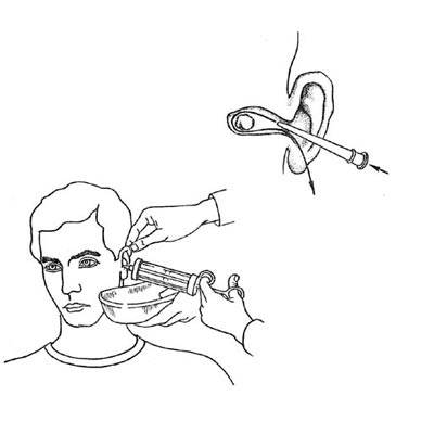 Удаление серной пробки из ушей: капли от заложенности, очистка в клинике