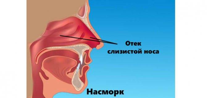 Сосуды в носу. Отек слизистой оболочки носа. Отек слизистроц ночэса.