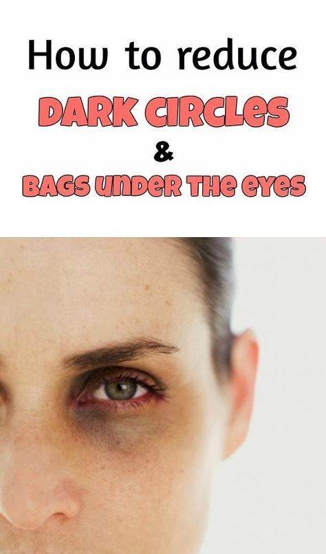 Как лечить синяк под глазом: серьезно ли это?