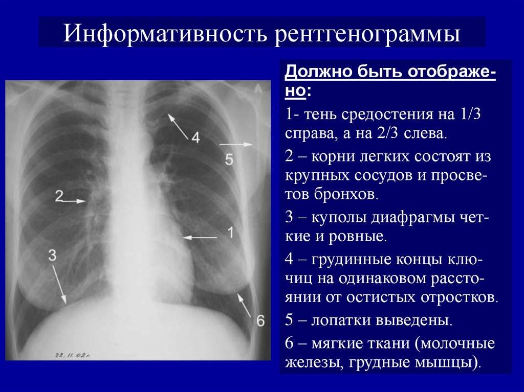 Схема чтения рентгенограмм