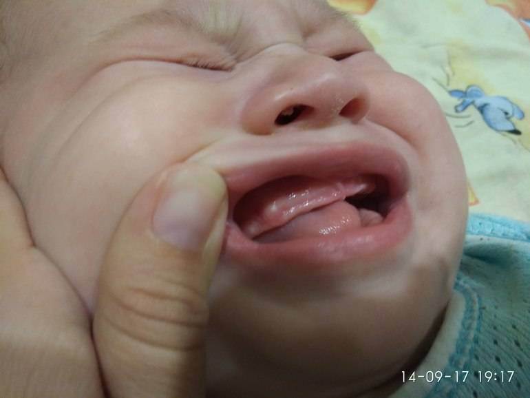 Симптомы прорезывания зубов у малышей