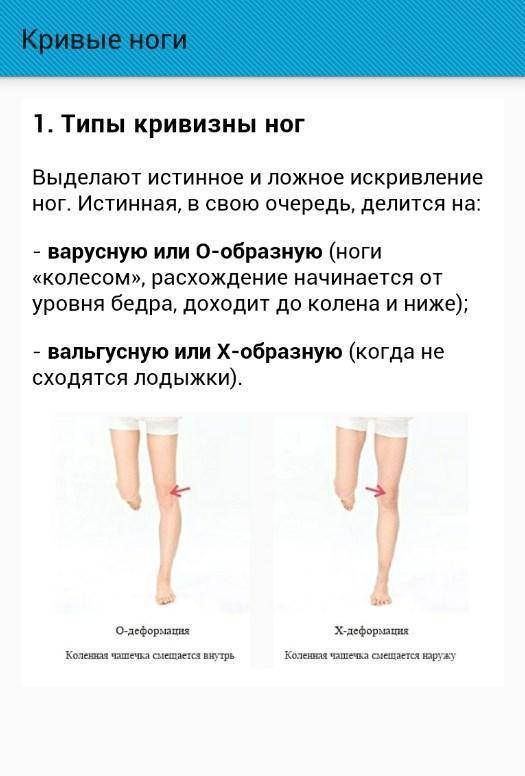 Коррекция варусной (о-образной) деформации ног — ladisten
