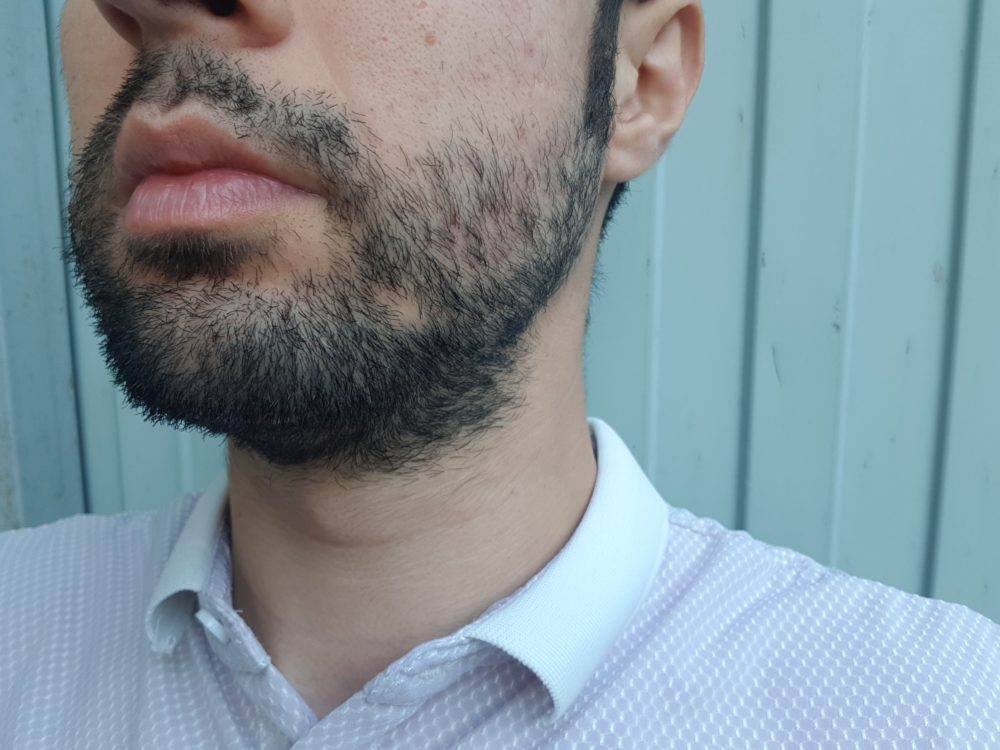 Что делать если борода прозрачная