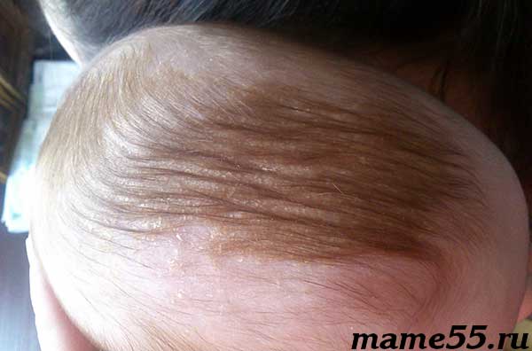 Грибок кожи головы: симптомы, лечение и профилактика