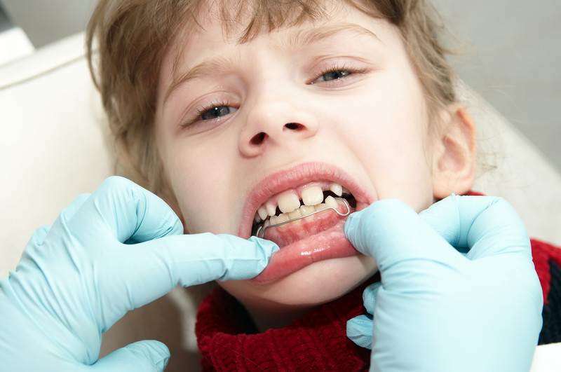 Молочный зуб: лечить или удалять?