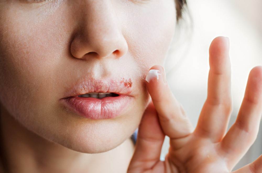 Виды герпеса на лице: в носу, на губах, подбородке и на глазу – симптомы и как лечить герпес