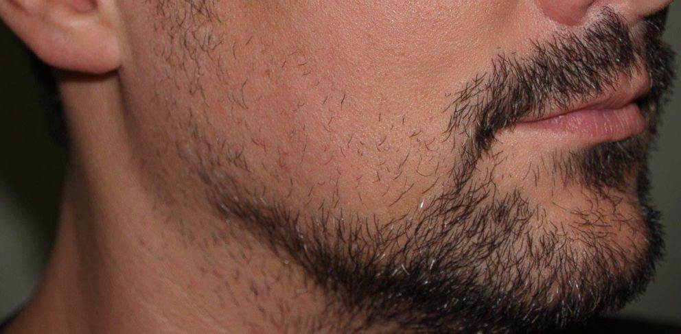 Не растет борода на щеках: возможные причины