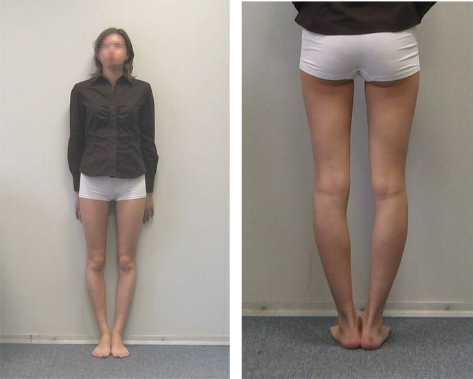 Коррекция формы ног: безоперационные и хирургические методы