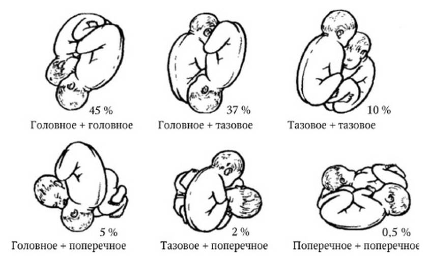 Что такое предлежание плода: виды, положение ребенка в матке по неделям беременности, перед родами