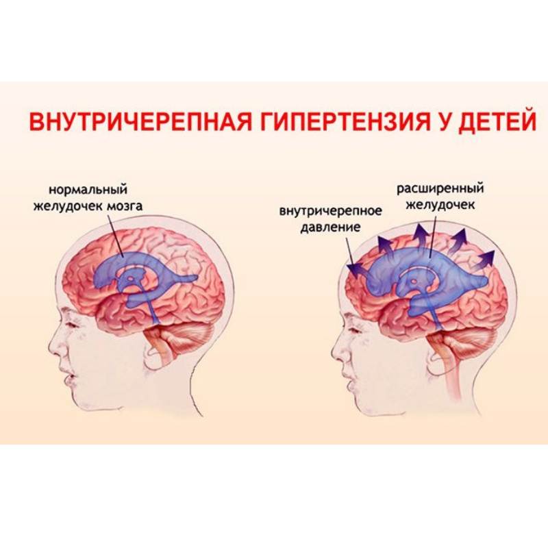 Давление при травме головы. Внутричерепная гипертензия симптомы. Повышение внутричерепного давления. Синдром внутричерепной гипертензии. Давление Черепного мозга.