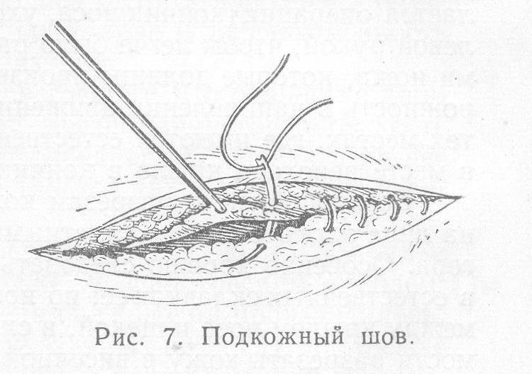 Снятие швов картинки