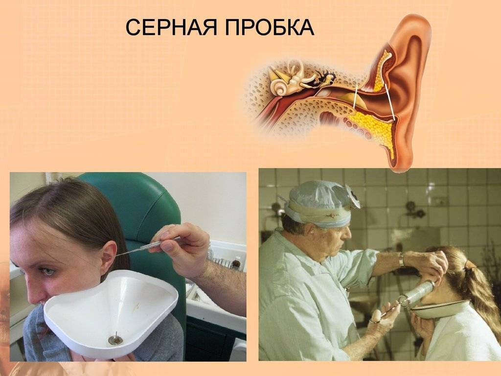 Удаление серной пробки из уха - от 1000 руб. цена в «клинике abc» в москве