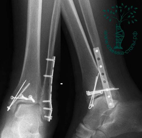 После перелома лодыжек ногу. Остеосинтез лодыжки реабилитация. Разработка голеностопного сустава после операции остеосинтеза. Перелом голеностопа реабилитация. Перелом лодыжки после операции.