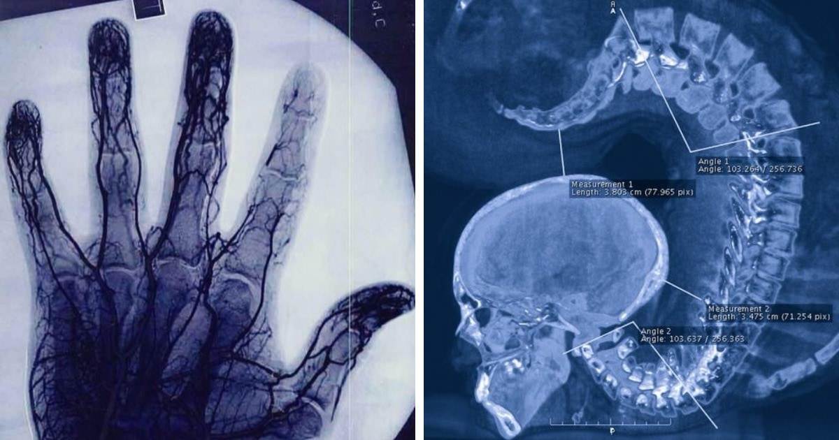 Прицельные рентгеновские снимки (targeted x-rays*)