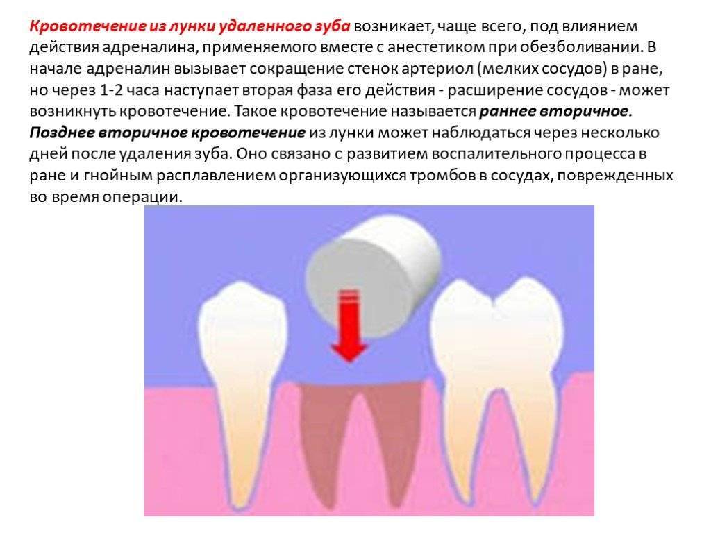 Положил лекарство в лунку. Кровотечение после удаления зуба. Кровотечение из лунки удаленного зуба.