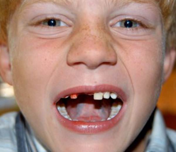 Удаление зубов. сколько зубов можно удалить одновременно?