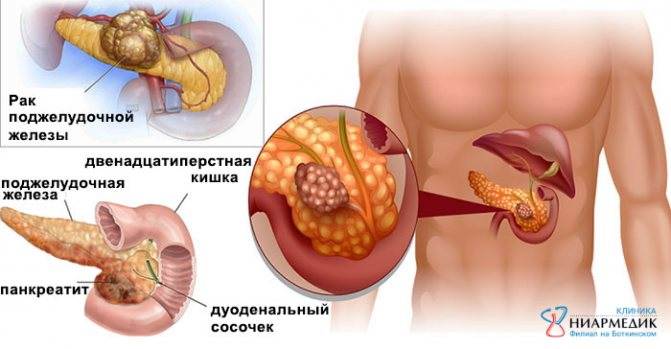 Болезни поджелудочной железы (панкреатит): симптомы, лечение, причины, диагностика, развитие