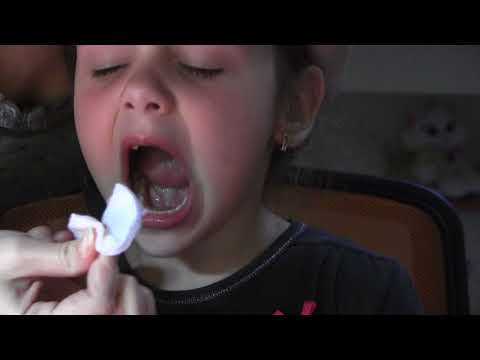 Удаление молочного зуба у детей: как и зачем