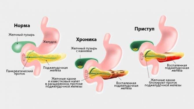 Лекарства от панкреатита поджелудочной железы: список лучших препаратов