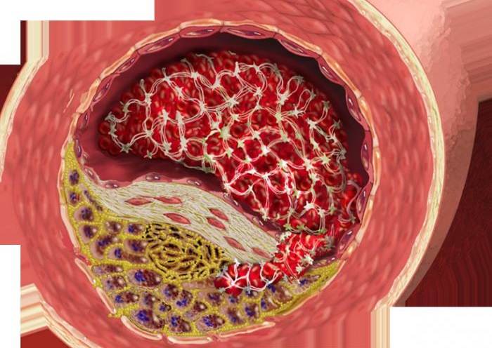 Атеросклероз нижних конечностей: причины, симптомы, диагностика и лечение оа артерий ног