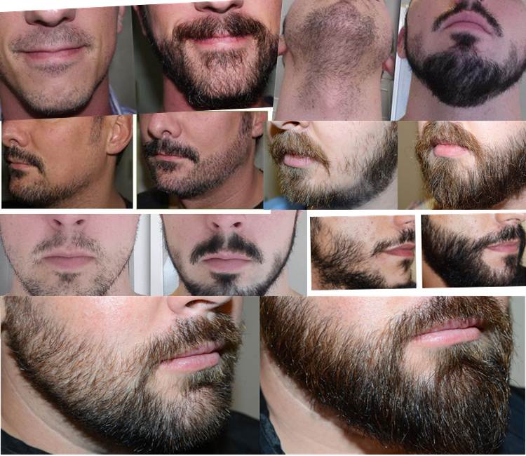 Что делать, если борода на щеках не растет: как найти причину и устранить ее