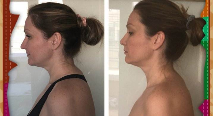 Убрать горб на шее: как избавиться если на шее растет горб в клинике cтопартроз