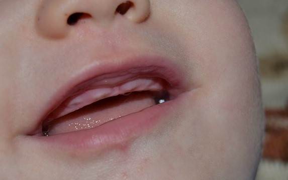 Прорезывание зубов у детей