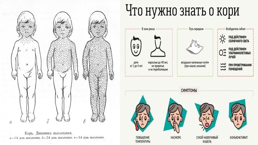 Корь симптомы у детей лечение инкубационный. Корь и краснуха различия в сыпи. Сыпь корь краснуха сыпь. Корь краснуха симптомы у детей. Корь у детей у детей клинические рекомендации.