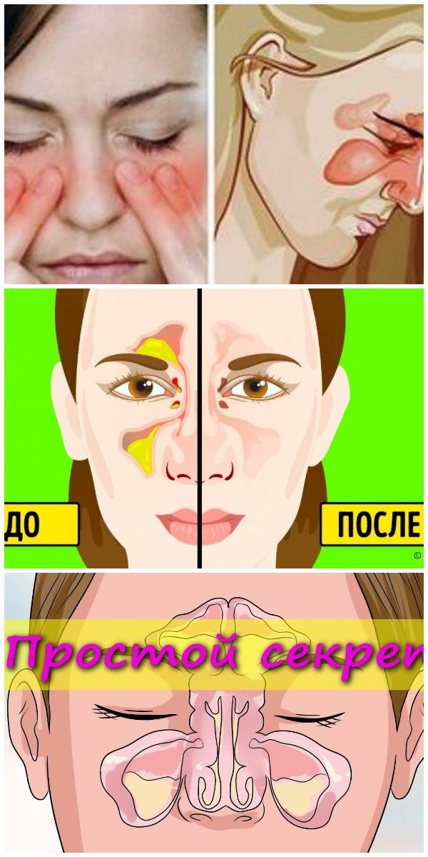 Медикаментозный ринит: как победить зависимость от капель для носа