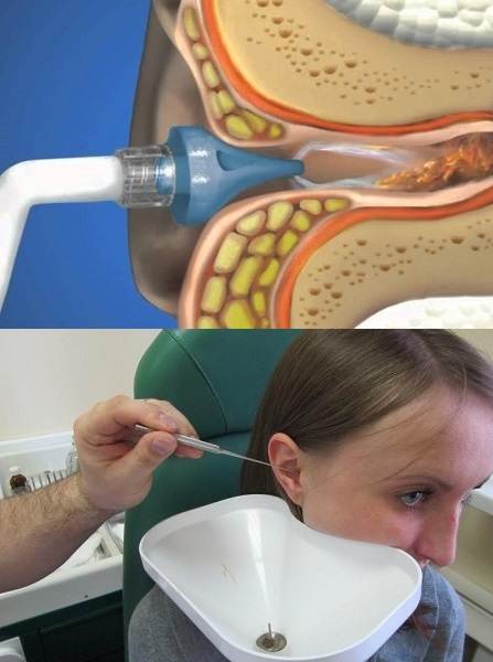 Как выглядит серная пробка в ухе и как избавиться от нее — лечение и удаление дома