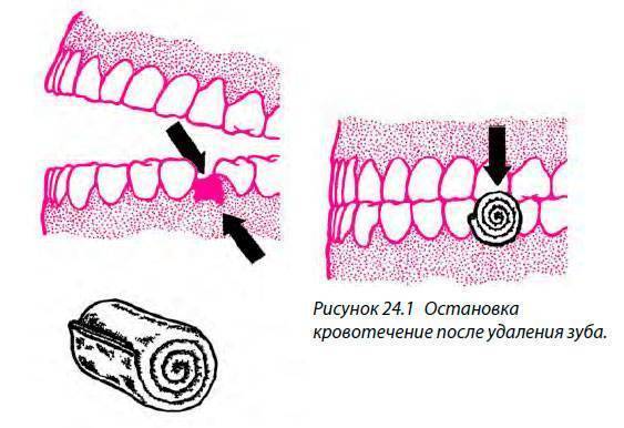 Остановить кровотечение удаления зуба